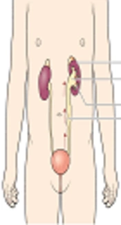 The Relationship Between Vesicoureteral Reflux and Recurrent Urinary Tract Infection in Children in Kurdistan Region, Iraq